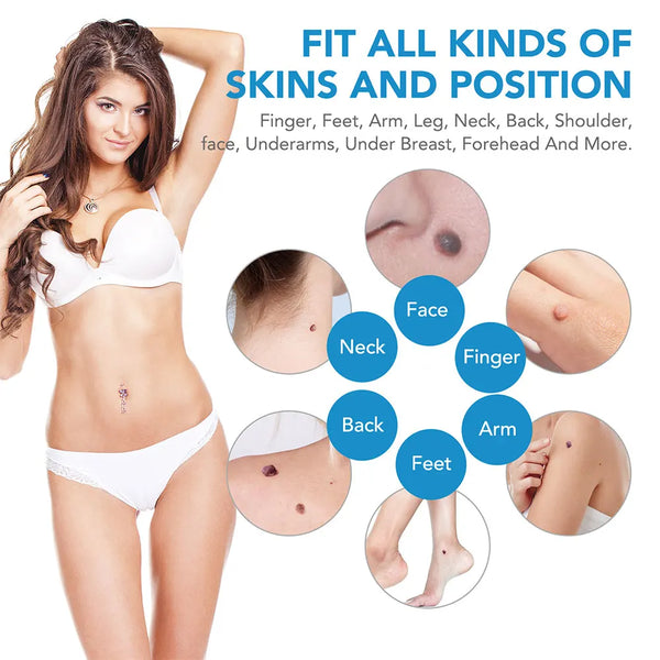 Easy Skin Tag Remover Kit